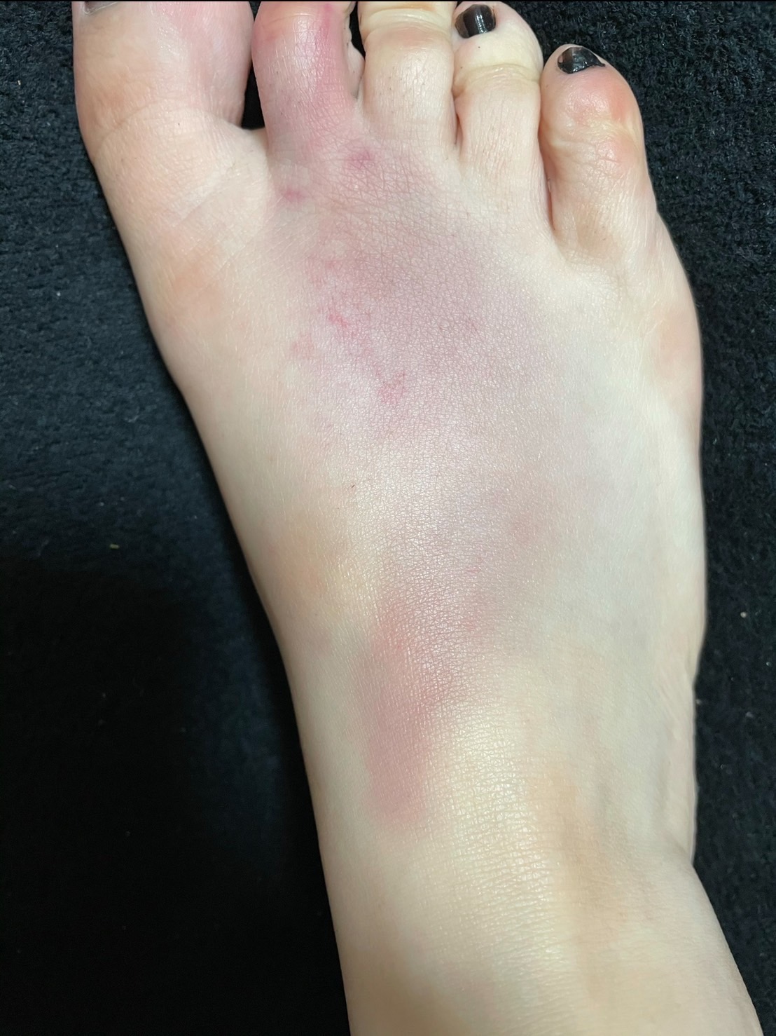 アフターケア:保冷→温タオル→保湿で整える足のコンディション - Doracula Queen 金蹴り 体験談|足のアフターケア(保冷・温タオル・保湿)の記録