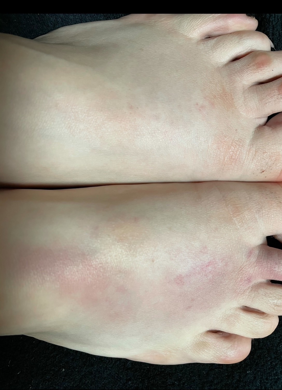 2アフターケア:保冷→温タオル→保湿で整える足のコンディション - Doracula Queen 金蹴り 体験談|足のアフターケア(保冷・温タオル・保湿)の記録